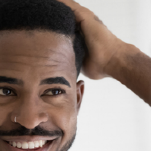 Afro Hair Transplant: Why Choosing the Right Hands Matters More Than Ever