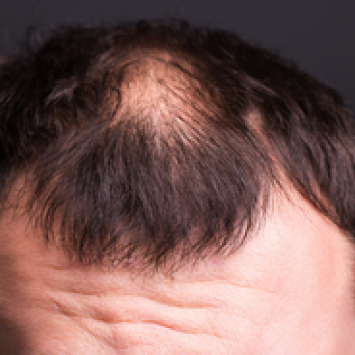 Am I a Suitable Candidate for Sapphire Hair Transplantation Treatment?