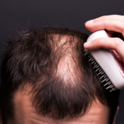 Do transplanted hair look natural?