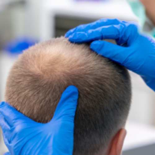 Does the Transplanted Hair Fall Out after Hair Transplantation?