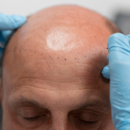 Hair Transplantation Myths and Facts