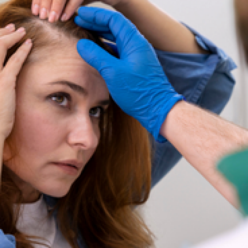 Hair Transplantation for Women