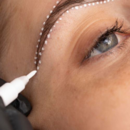 In Which Situations Is Eyebrow Transplantation Performed?