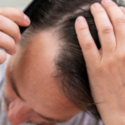 What Causes Shock Loss After Hair Transplantation?