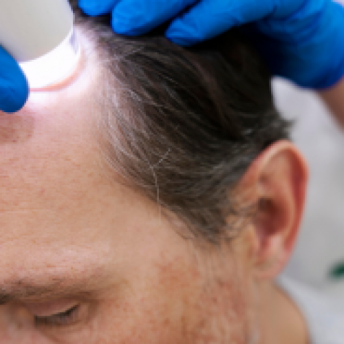 What are the Advantages of FUE Method?