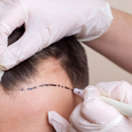 What are the Differences Between DHI and FUE Hair Transplantation?