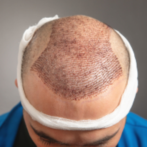 What is Hair Transplantation