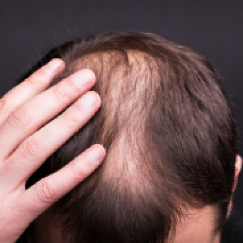 What is hair transplantation?